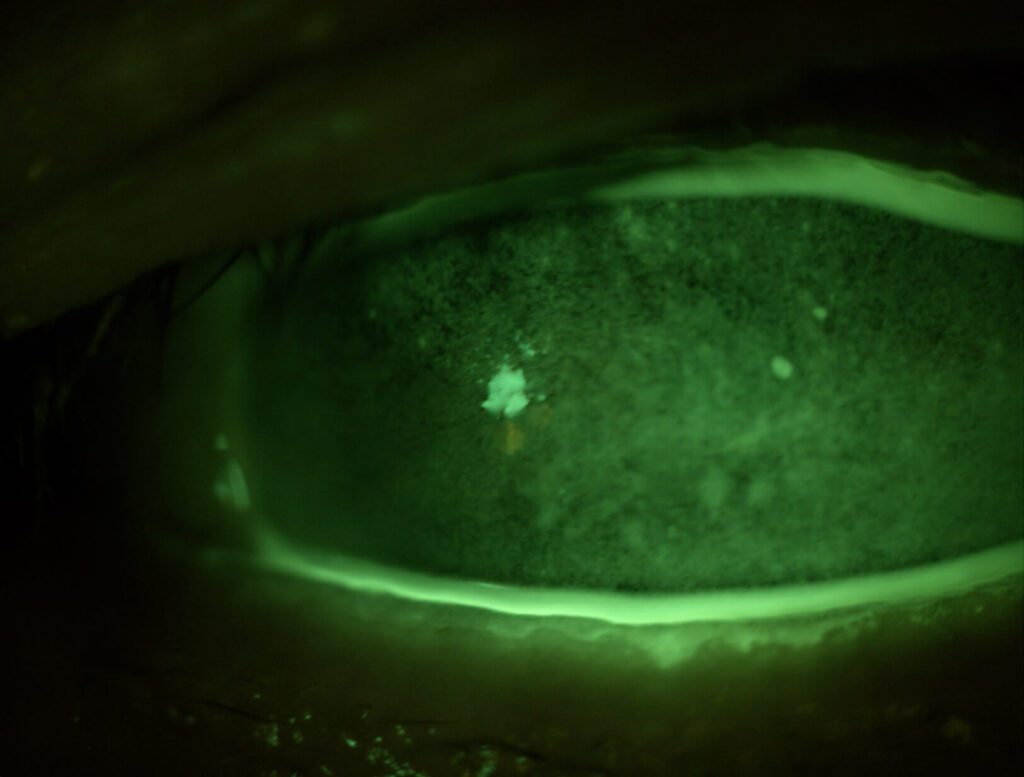 Deze afbeelding laat een hoornvlies zien met aanzienlijke schade door droog oog