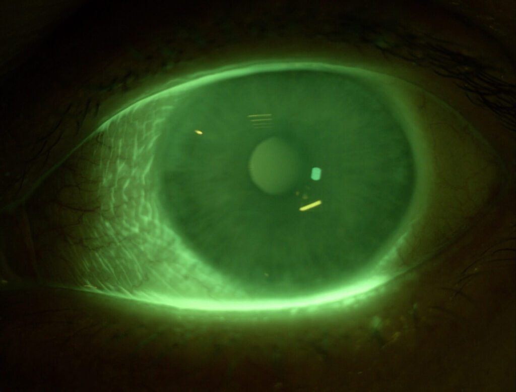 Deze afbeelding laat een normaal oog zien